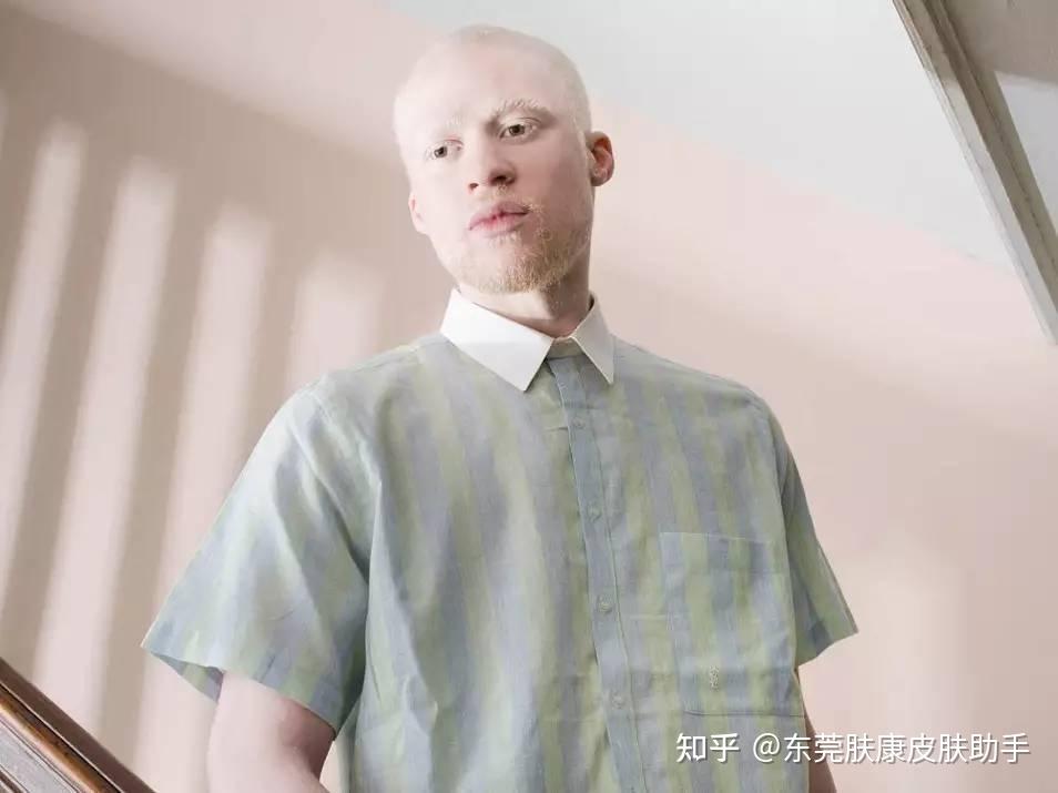 皮肤白的离谱？ 白化病 知乎 