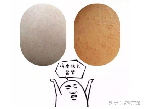 毛孔鸡皮肤(皮肤毛孔像鸡皮一样)