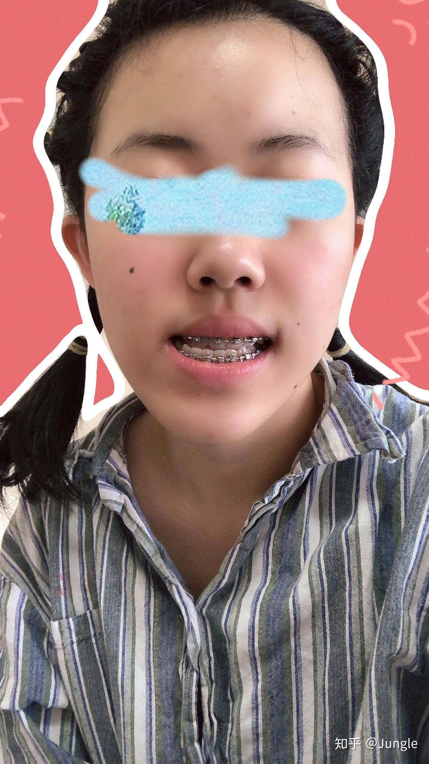 做正颌手术是怎样的体验？