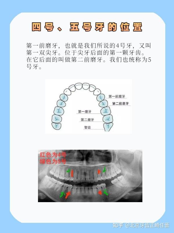 牙齿矫正为什么大多数拔4,5号牙?有区别吗?哪个内收效果更好?