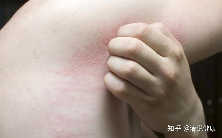 肝病出现较为隐匿身体不会喊疼但皮肤早已给过警示