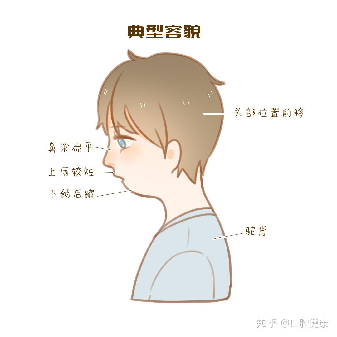 口呼吸的危害