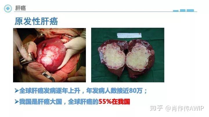 中国医师协会癌症的真相为什么会长肿瘤恶性肿瘤常见表现检测与治疗