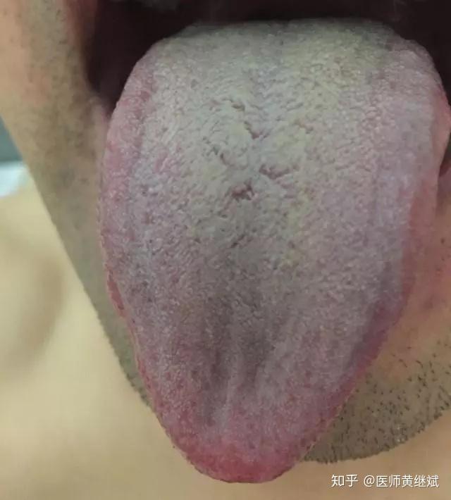 辛开苦降法是恢复胃气和食欲调理脾胃气虚的首选方法