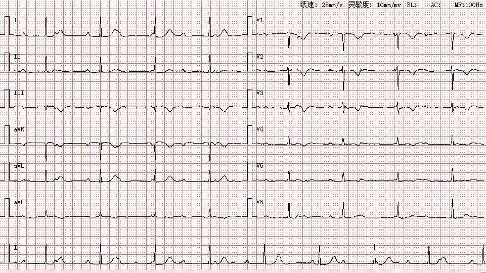 心电图图谱 4如图所示,p波在Ⅰ,Ⅱ,avf,v4