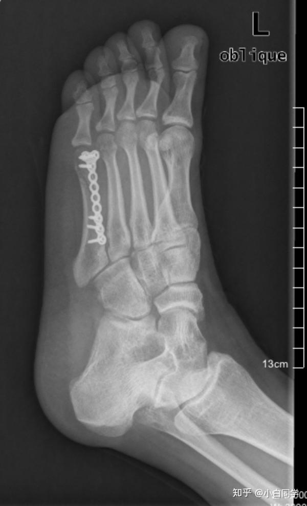 左足第五跖骨骨折康复记录 第五跖骨骨折严重吗 茶文网