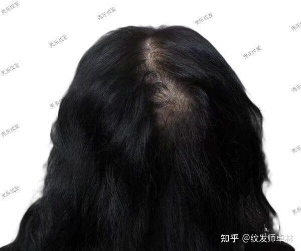 脱发女士需知的纹发常识：先进的smp纹发技术并不仅仅适用于男性！ - 知乎