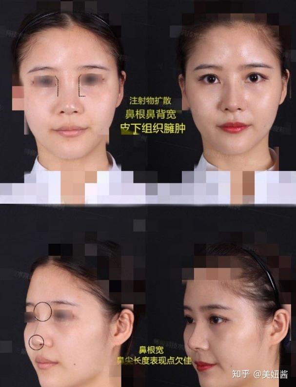 隆鼻老了以后会怎么样假体需要定期更换吗