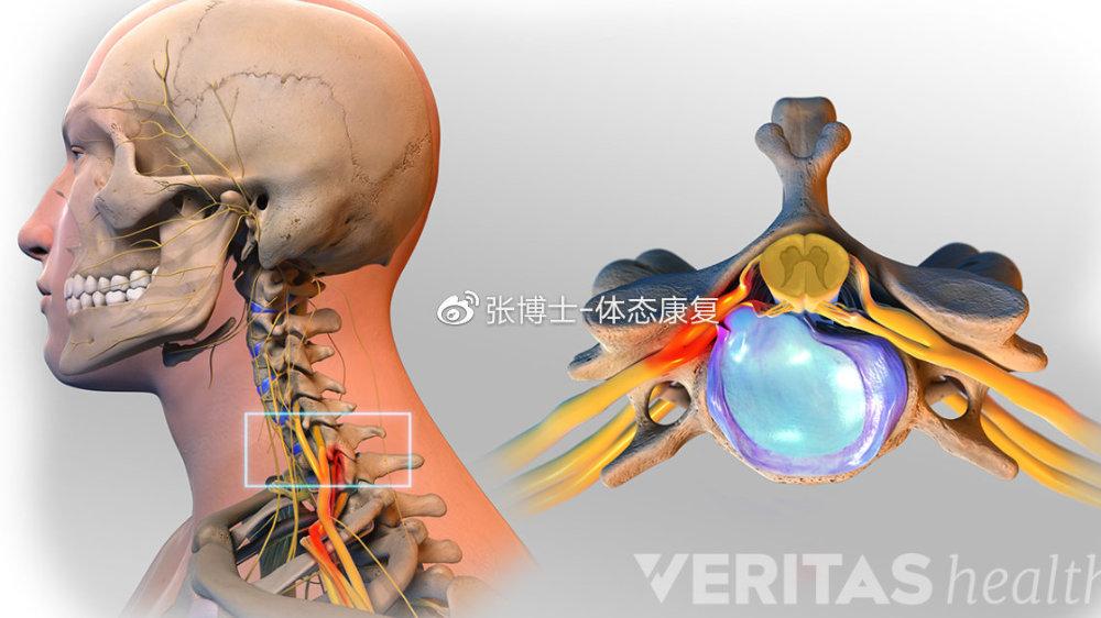 运动康复科普 颈椎间盘突出简述与康复训练 知乎 运动康复科普 颈椎间盘突出简述与康复训练 知乎
