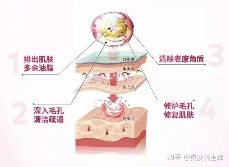 化学换肤术你了解多少
