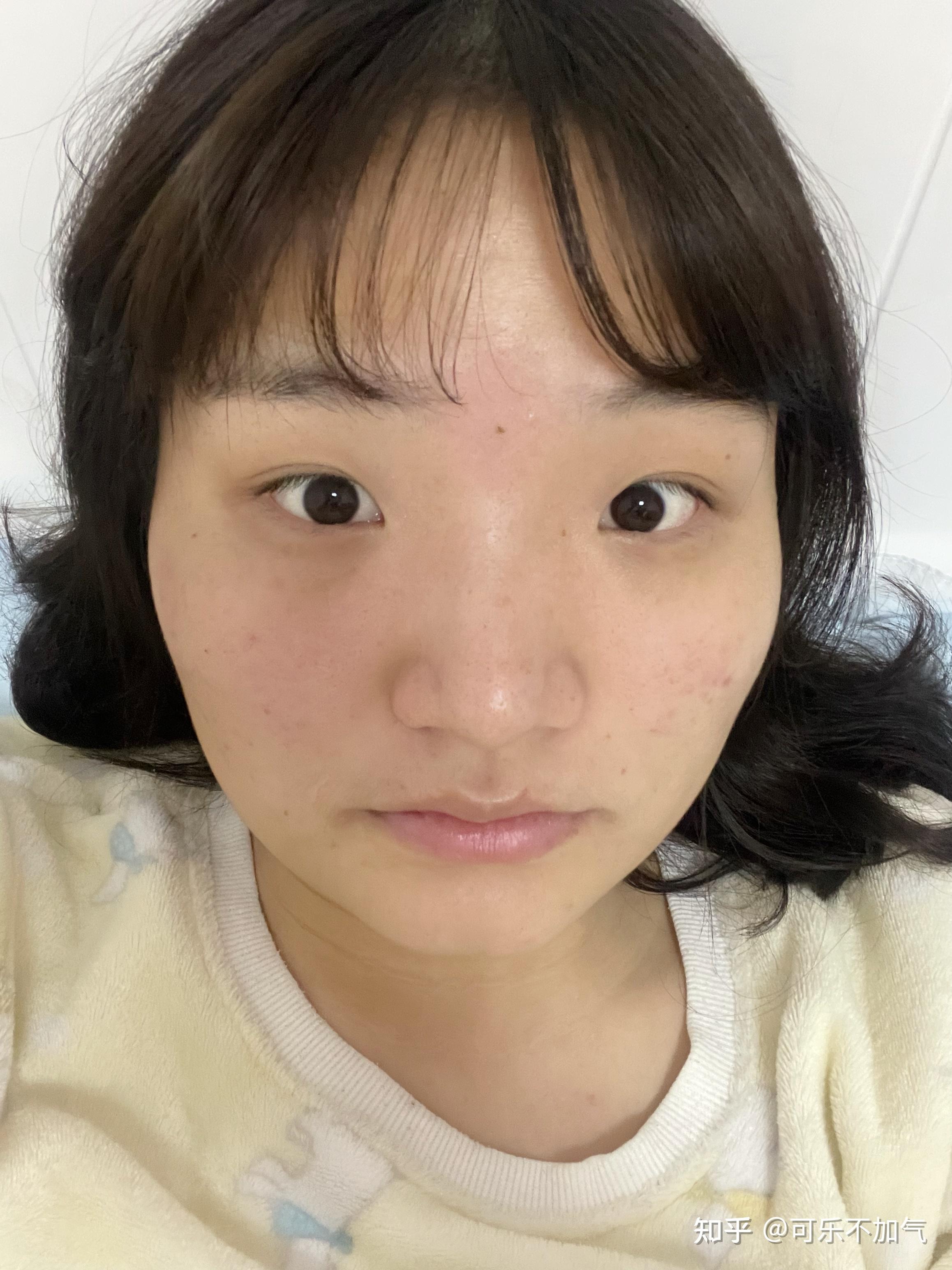 高颧骨 眼睛宽 双眼无神该怎么整