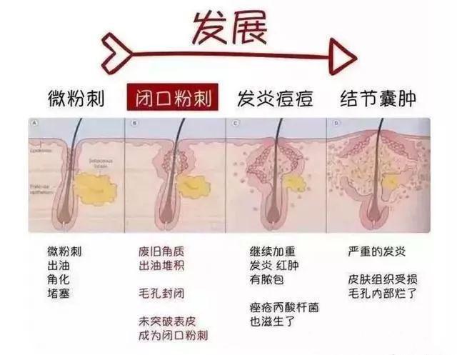 青春痘的生長因素有哪些?