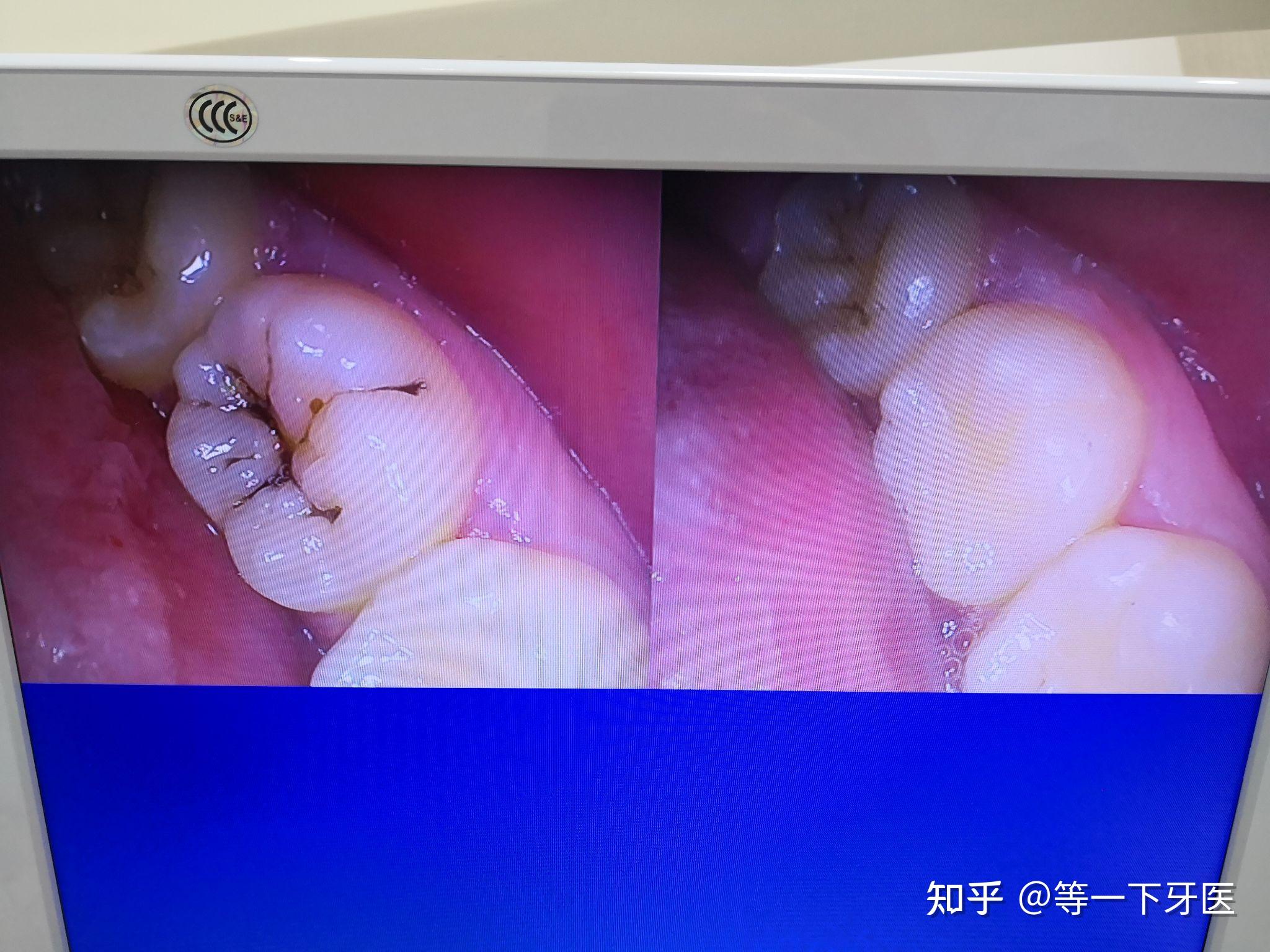 补牙对比和过程