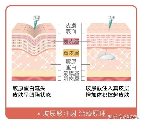 玻尿酸注射层次图片