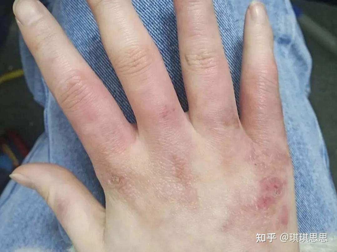 冻手冻脚怎么办