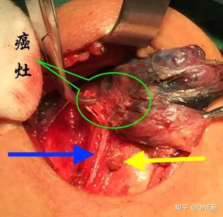 图文解说甲状腺结节离患癌远吗附投保全攻略