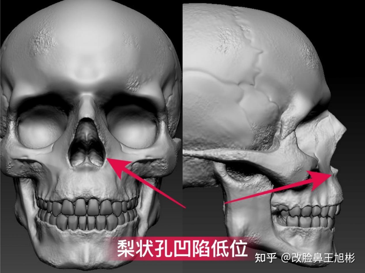 鼻基底位于上颌骨中心梨状孔周围,也就是鼻子和面中连接的部位,又可