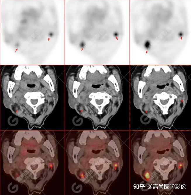 PET-CT诊断鼻咽癌病例分享 - 知乎