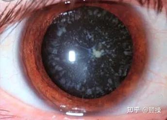 引起白瞳症最常见的儿童眼病是什么? - 知乎