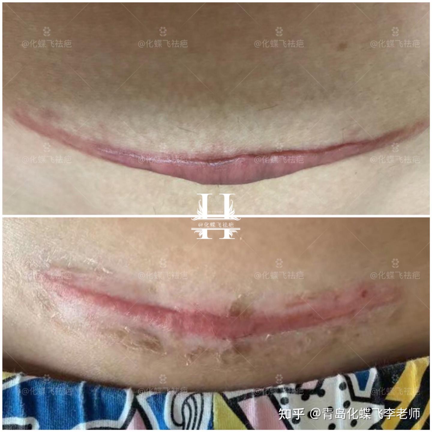 重度剖腹产增生疤痕 - 知乎