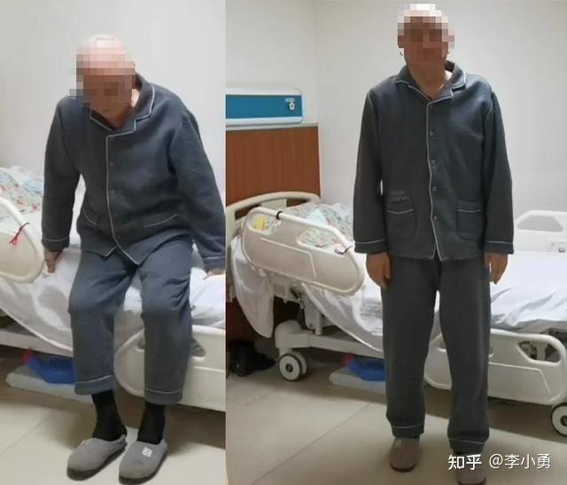 老年正常压力脑积水首次腰大池分流术失败并颅内出血手术后,在多方