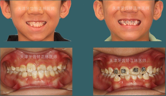 种植牙医生刘成龙 67 郑州大学医学硕士 地包天的.也叫兜齿.