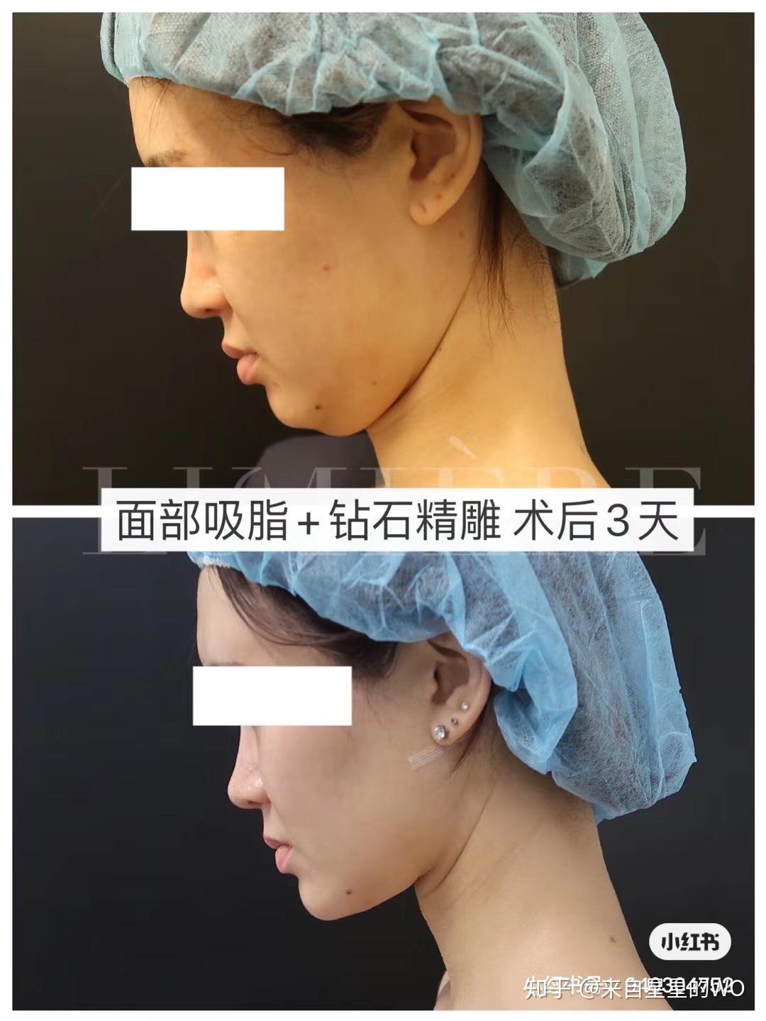 悉尼抽脂lumiere钻石精雕抽脂