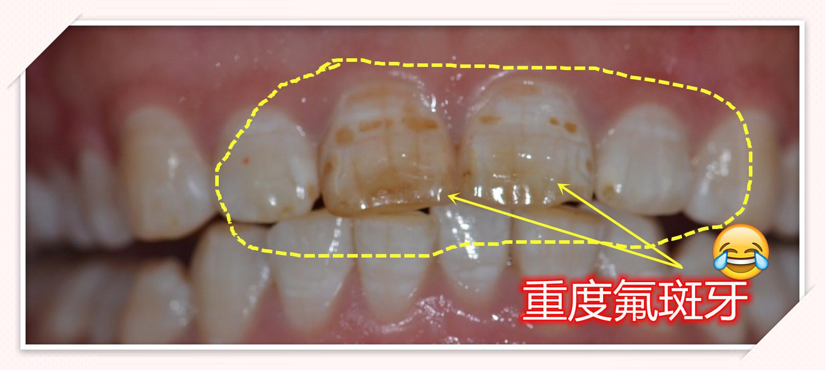 診斷結果:門牙為重度氟斑牙,旁邊牙齒