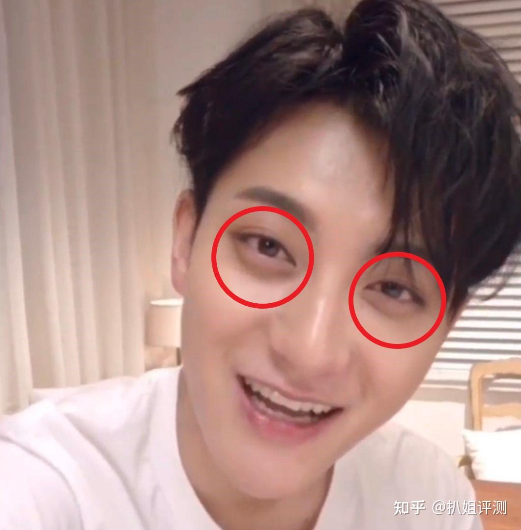 先天型黑眼圈,属于基因造成的黑眼圈,比如黄子韬,用啥眼霜都没用.