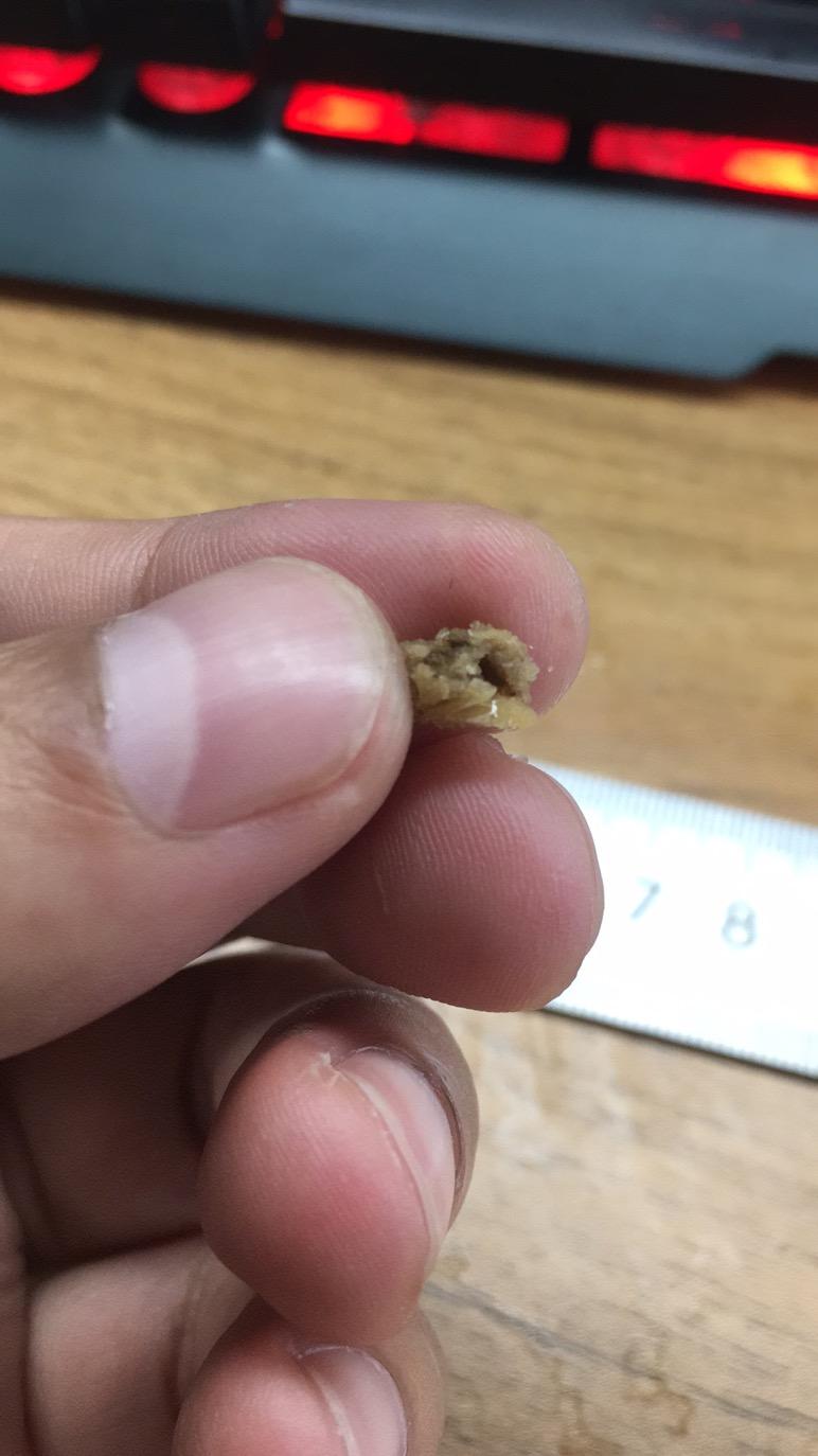 肾结石排石经历