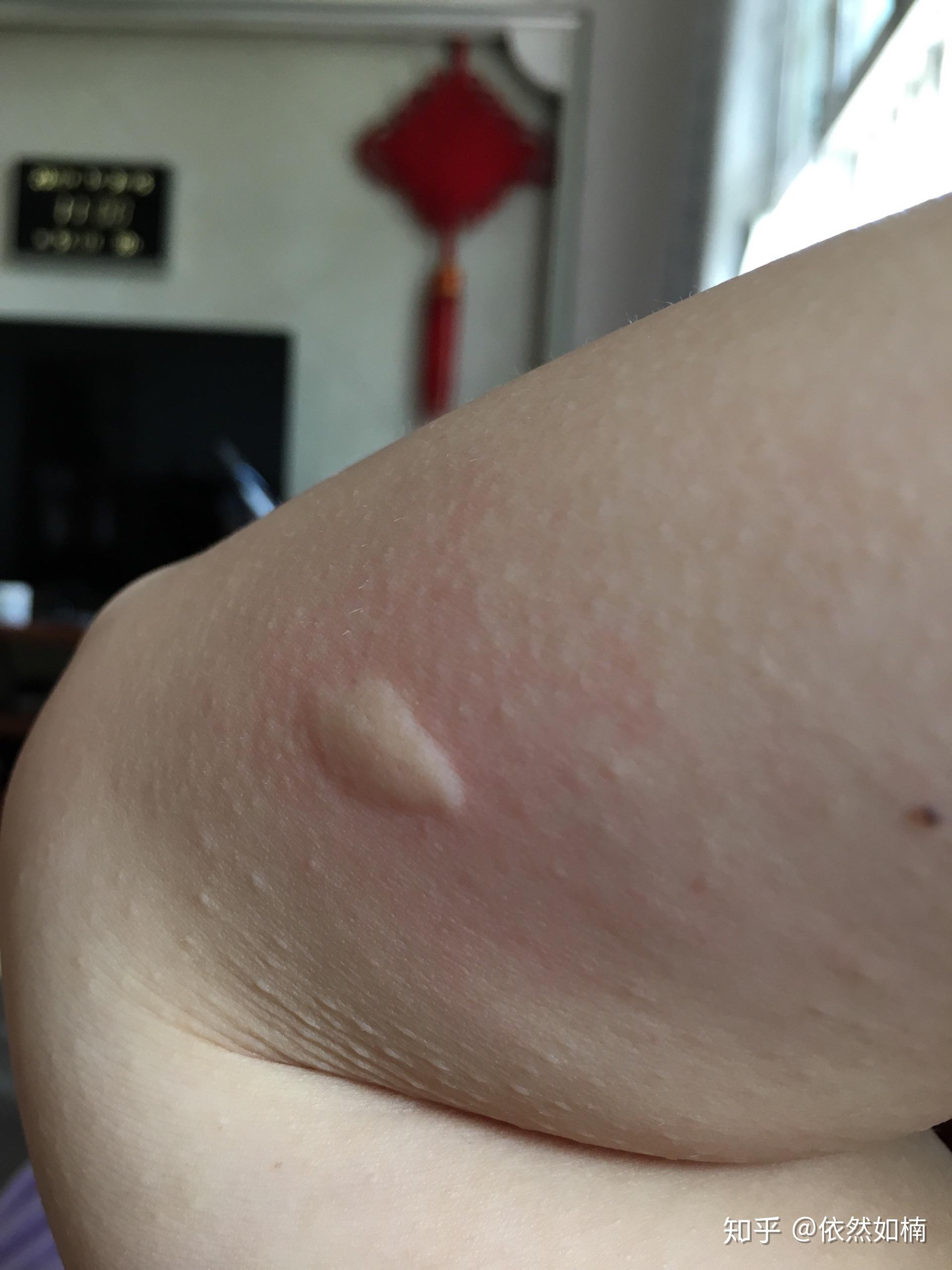 吃了几天的肤痒颗粒感觉没有效果