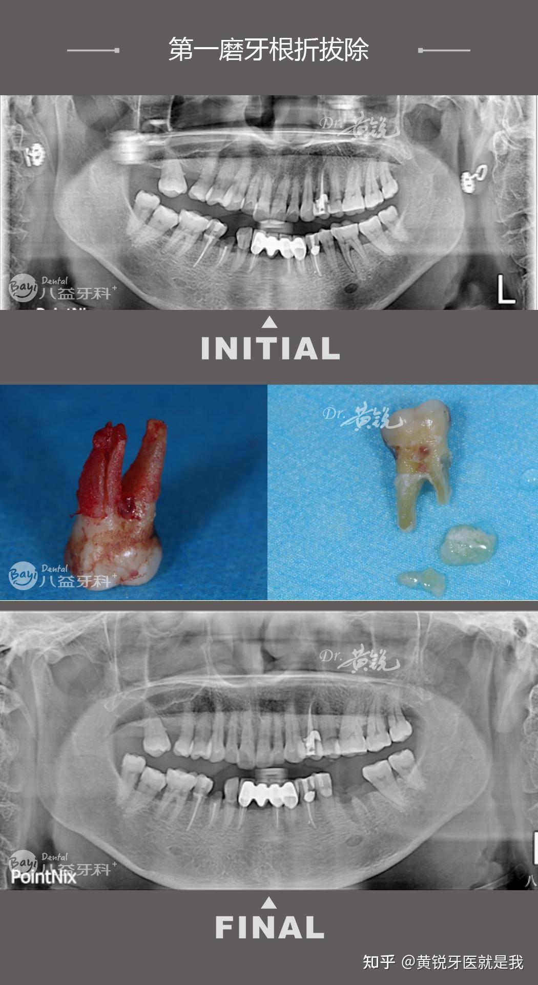 分享第一磨牙根折拔除