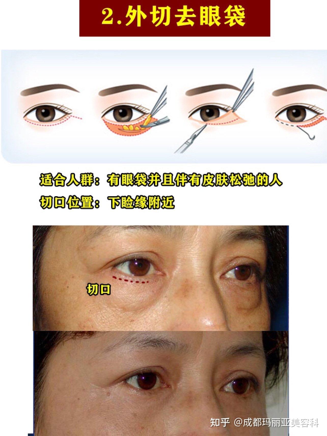 不开刀如何去眼袋?去眼袋功课 避雷必看!