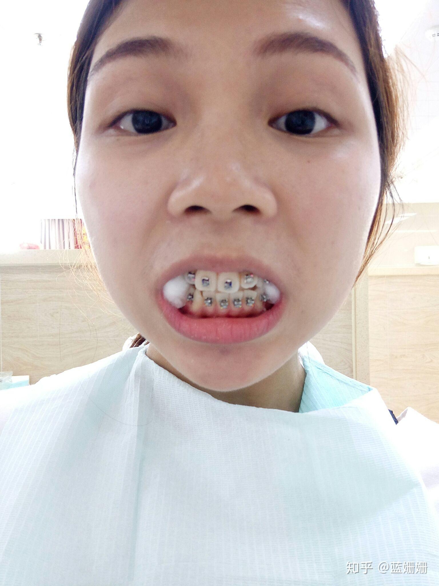 正畸女孩的日志