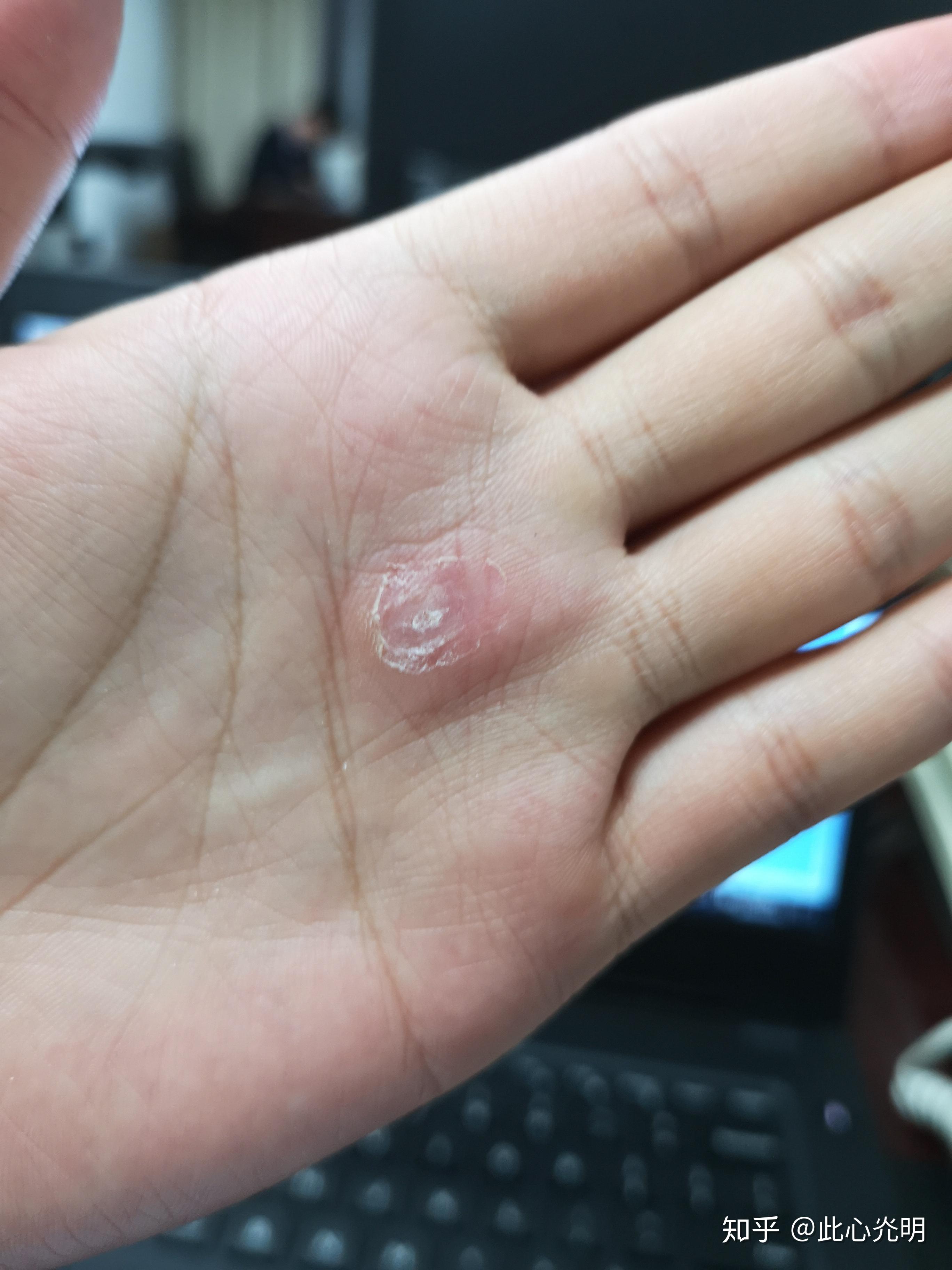 鸦胆子去寻常疣过程