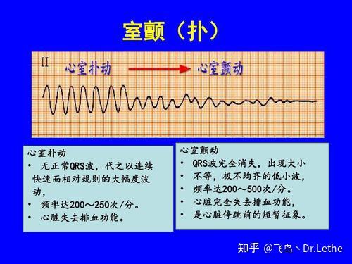 系统学习心电图-2 异常心电图判读 - 知乎