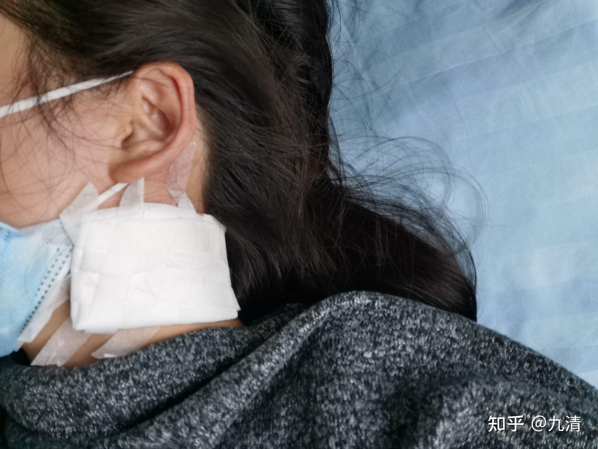 淋巴穿刺疼吗? - 知乎