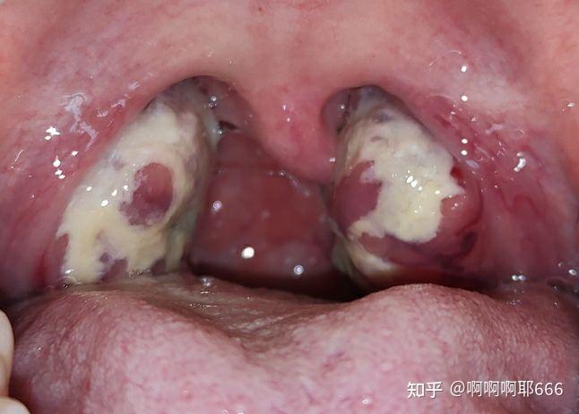 咽部化脓图片图片