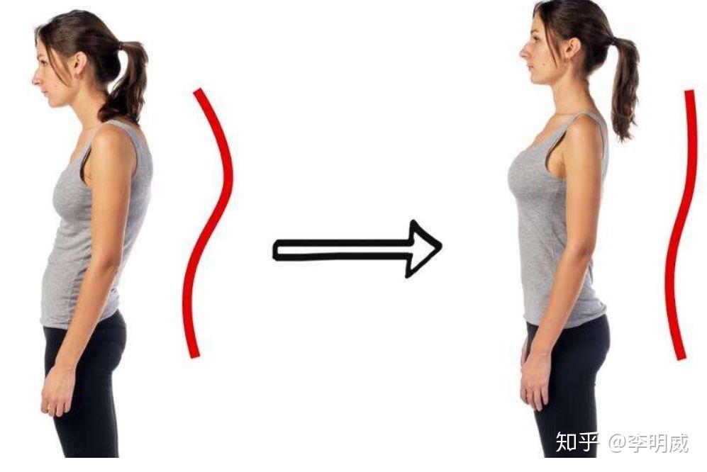 2 头前倾,含胸驼背