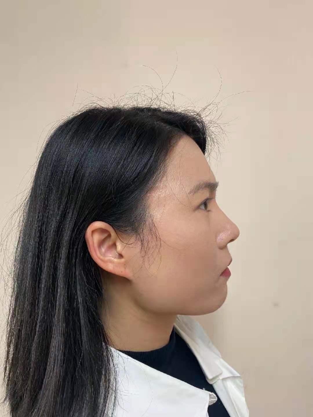 上海下颌角哪个医生做的好九院的袁捷韦敏柴岗怎么样