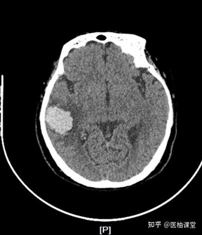 影像CT带你了解脑出血 - 知乎