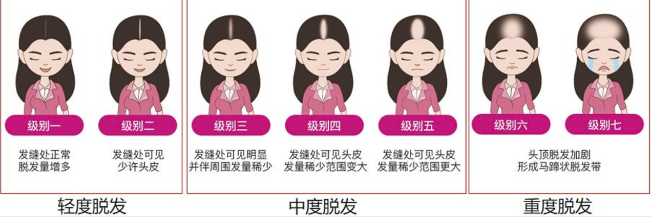 女性型雄激素性秃发脱发-宜昌荆州襄阳丝域养发馆防脱科普 - 知乎