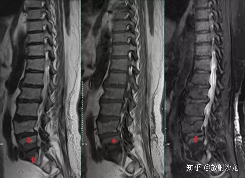 椎体终板炎 | 发生机制、分型以及 MRI 表现 - 知乎