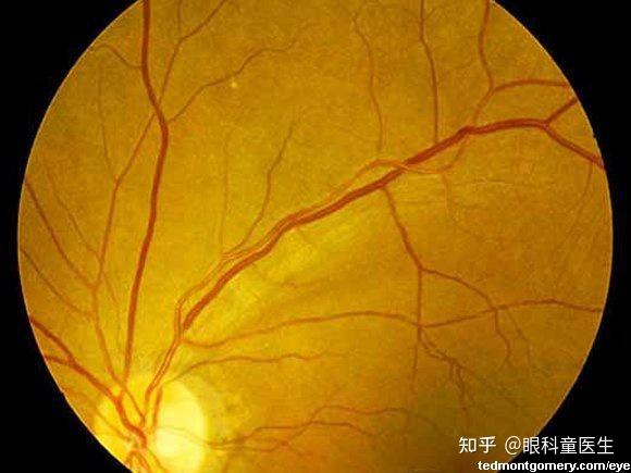 与系统性疾病相关的视网膜病变1高血压动脉硬化性眼底改变改变