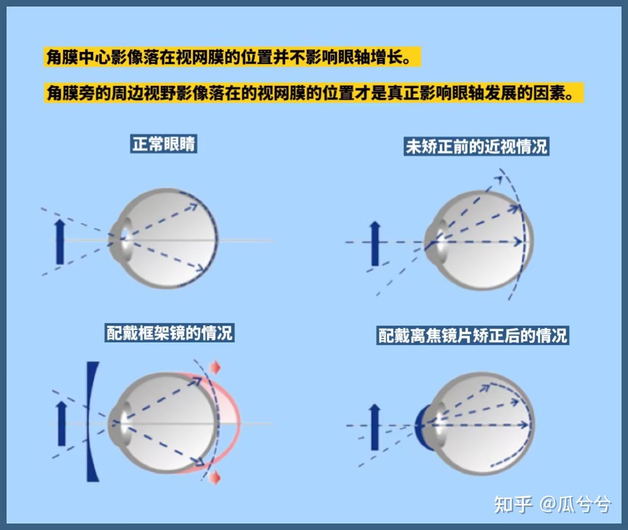 近视离焦 - 知乎