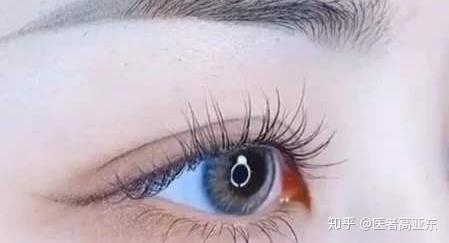 什么手术可以让眼睛变大 v2-bc4329ae429243ea52db52a37c77c768_r.jpg