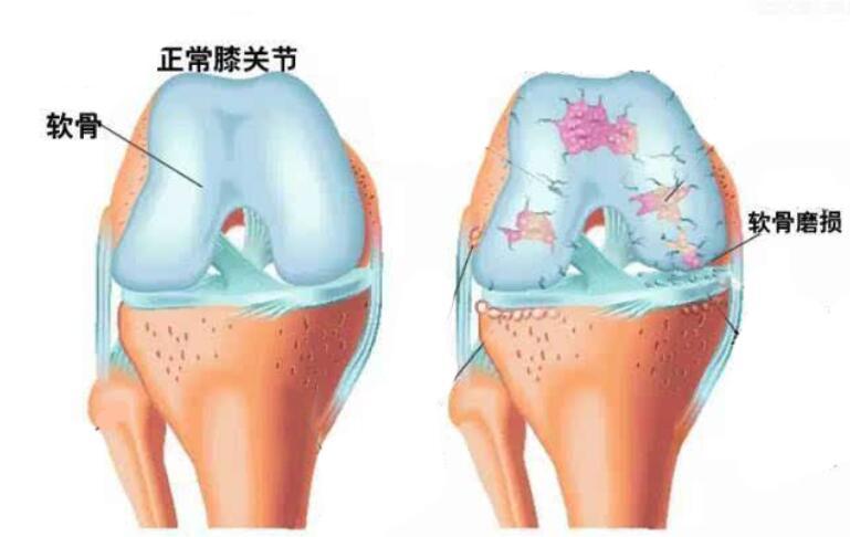 疼痛,长期反复摩擦甚至会使髌股和股骨表面的软骨发生不可逆的磨损