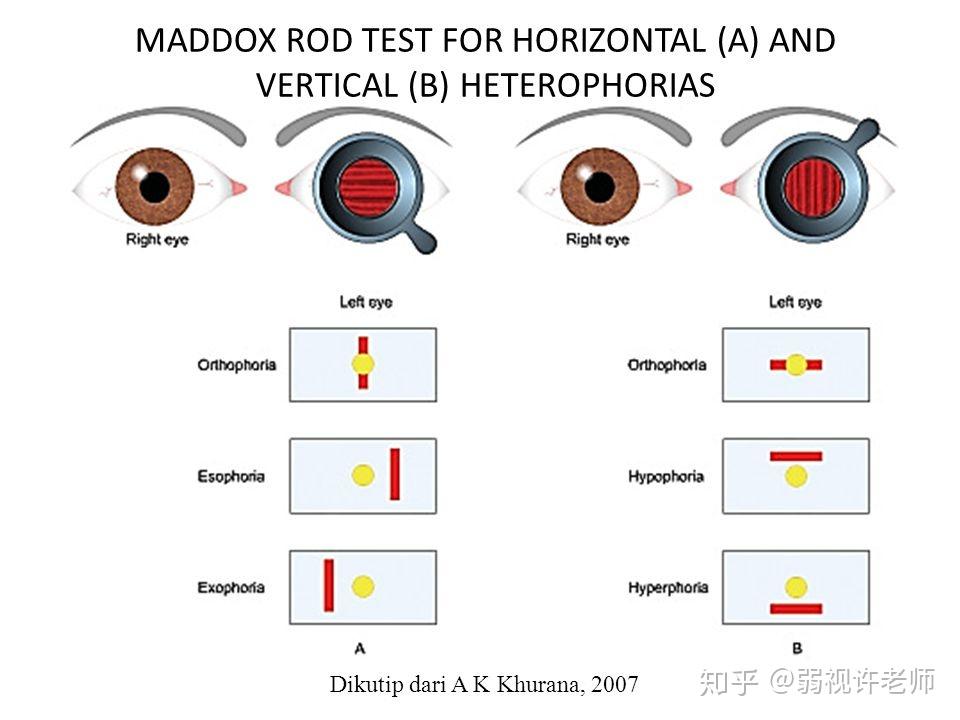 干货，隐斜检查系列（三）——安利一种傻瓜式隐斜检查方法，一分钟就能学会 知乎