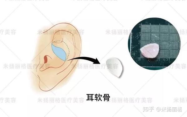 隆鼻 为什么医生都推荐软骨垫鼻尖 而不是用假体呢 知乎 隆鼻 为什么医生都推荐软骨垫鼻尖 而不是用假体呢 知乎