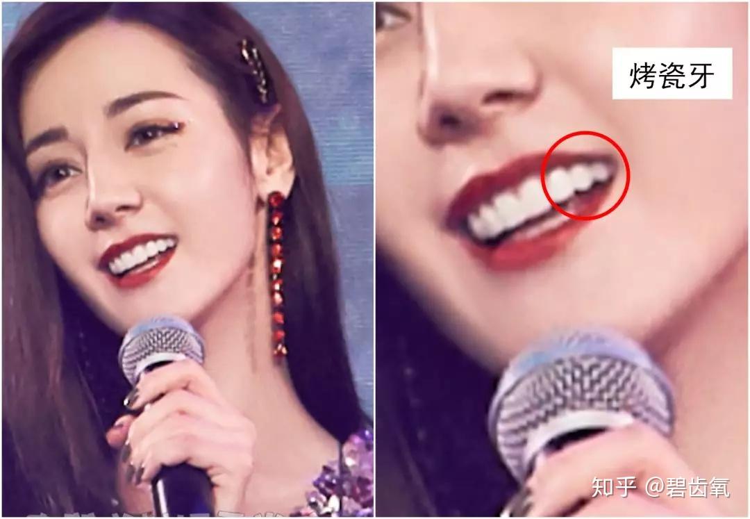 烤瓷牙选手热巴代言美白牙膏?黑人,你认真的吗